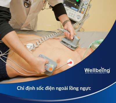 Chỉ định sốc điện ngoài lồng ngực| Wellbeing