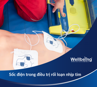 Sốc điện trong điều trị rối loạn nhịp tim| Wellbeing