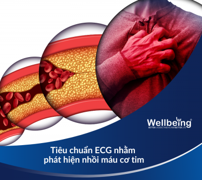 Tiêu chuẩn ECG nhằm phát hiện nhồi máu cơ tim