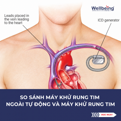 COMPARISON: AUTOMATED EXTERNAL DEFIBRILLATOR (AED) VS. IMPLANTABLE CARDIOVERTER DEFIBRILLATOR (ICD) | WELLBEING