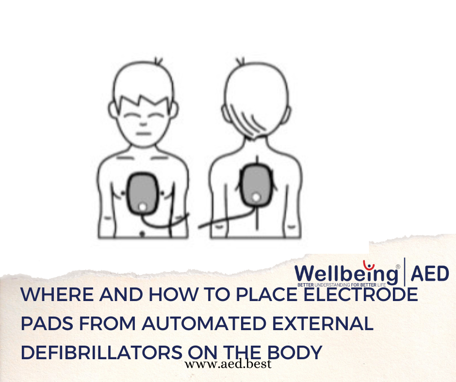 WHERE AND HOW TO PLACE ELECTRODE PADS FROM AUTOMATED EXTERNAL DEFIBRILLATORS ON THE BODY | WELLBEING