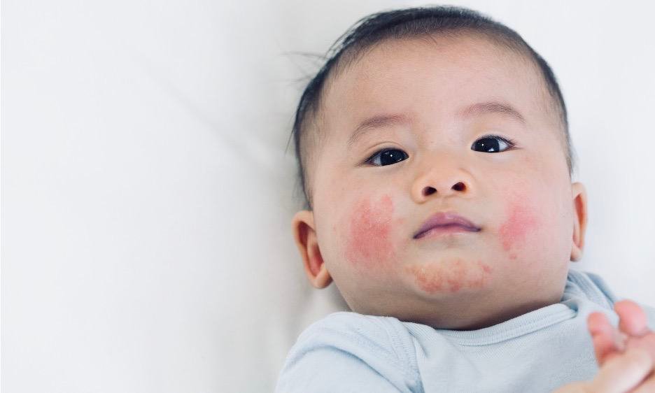 Nhan-biet-va-xu-tri-di-ung-o-tre-nho